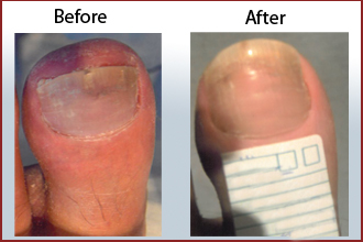 Beauchamp Foot Care Offers One of the Best Treatments in London for Getting Rid of Toenail Fungus