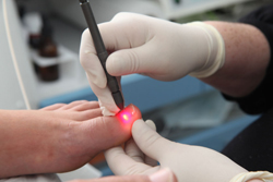 Beauchamp Foot and Nail Laser Clinic Offers Free Consultation for Leading Toenail Fungus Laser Treatment in London