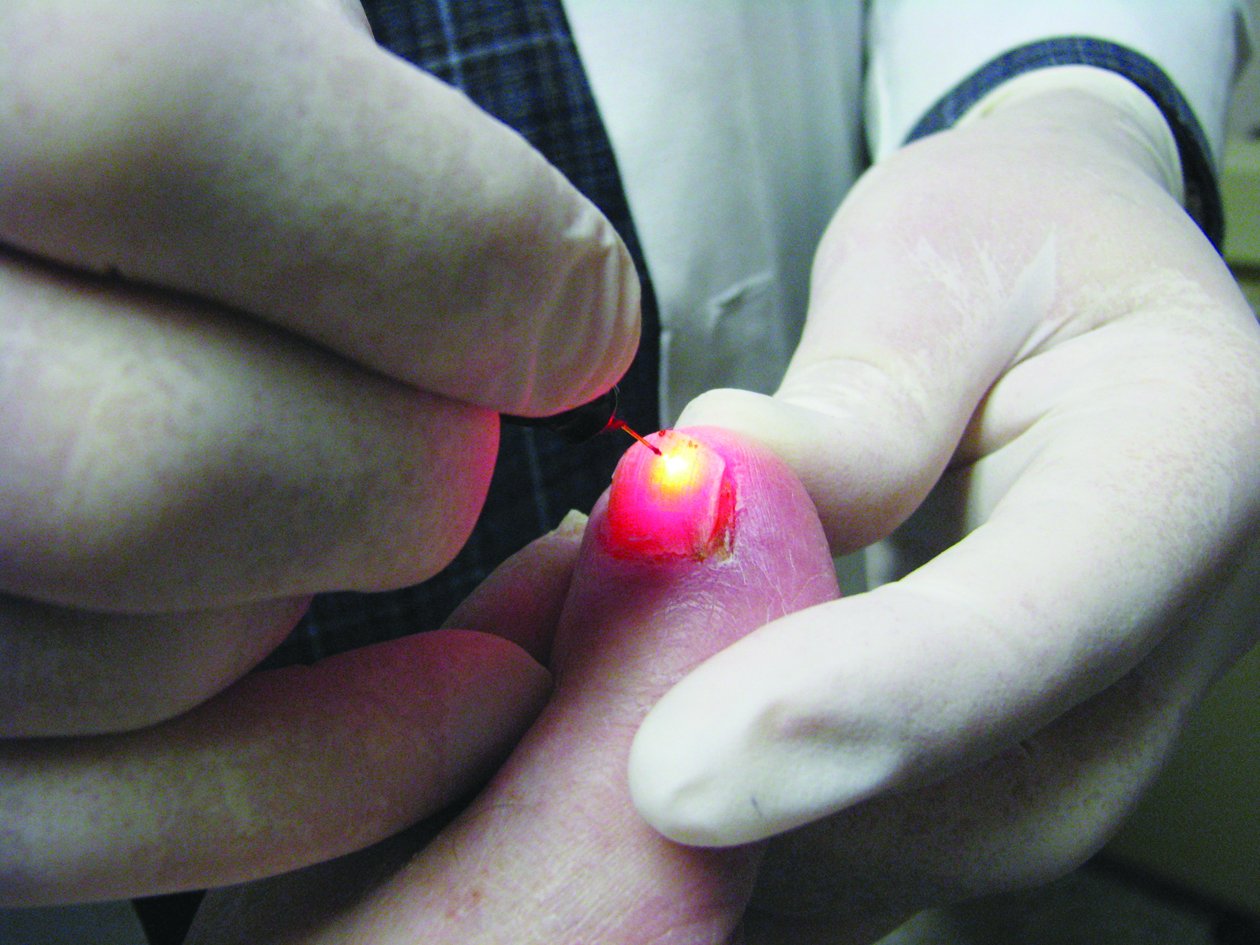 Dr. Michael Uro Foot Care, Sacramento Offers a Breakthrough Solution for
Toenail Fungus Laser Treatment